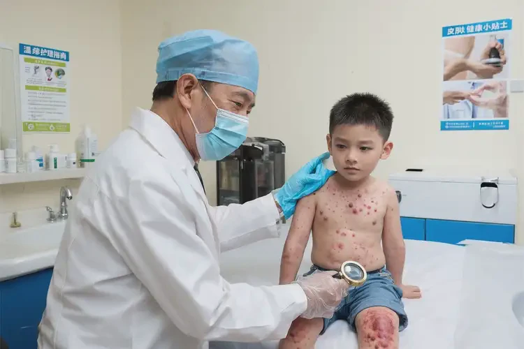 孩子全身出濕疹可以徹底自愈嗎(圖3)