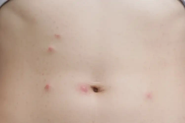 女人肚子容易長濕疹不管它會自己好嗎(圖1)