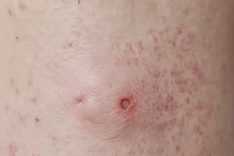 女生肛周起濕疹能靠自己自愈嗎(圖4)