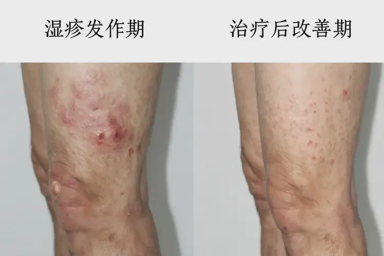 男性大腿上容易起濕疹可不可以徹底自愈(圖1)