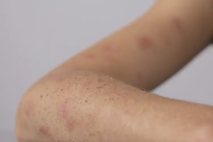 青少年手臂上起濕疹不管它會自己好嗎(圖4)