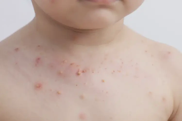 兒童脖子出現(xiàn)濕疹不管它會(huì)自己好嗎(圖3)