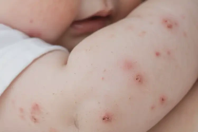 嬰兒身上容易長濕疹不管它會(huì)自己自愈嗎(圖4)
