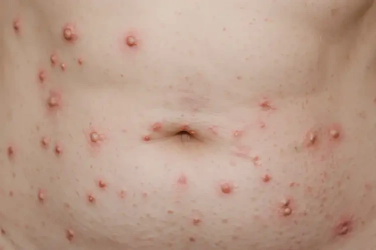 女人肚子上容易長濕疹不管它會自己痊愈嗎(圖4)