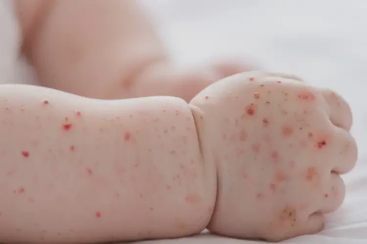 婴儿手臂上容易长湿疹能够彻底治愈吗(图4)