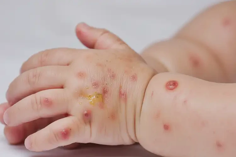 幼兒手上出現(xiàn)濕疹不管它會自己好嗎(圖2)