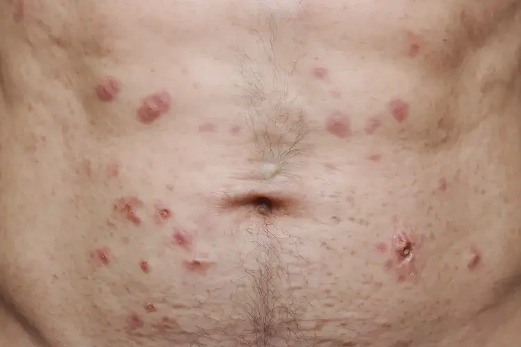 男性肚子上出現濕疹不管它會自己好嗎(圖1)