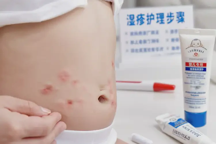 新生兒肚子上有濕疹不管它會自己自愈嗎(圖1)