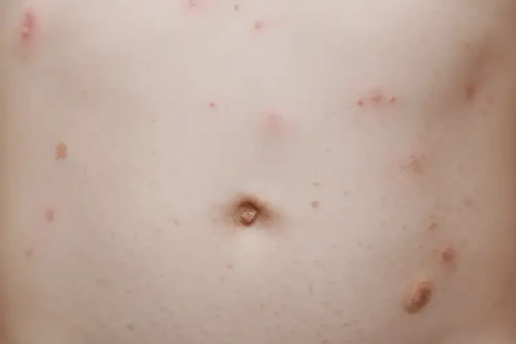 小兒肚子上偶爾起濕疹不管它會(huì)自己好嗎(圖4)