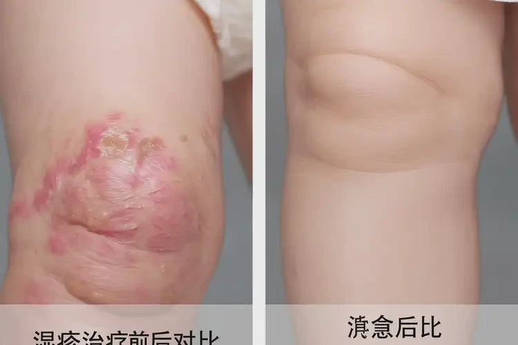 小兒小腿容易長(zhǎng)濕疹能夠徹底治愈嗎(圖4)