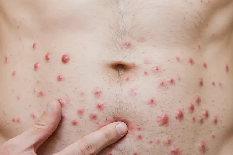 青年人肚子起濕疹不管它會自己痊愈嗎(圖4)