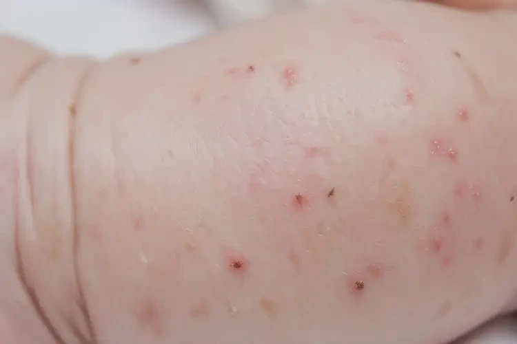 嬰兒四肢出現(xiàn)濕疹能夠徹底治愈嗎(圖4)