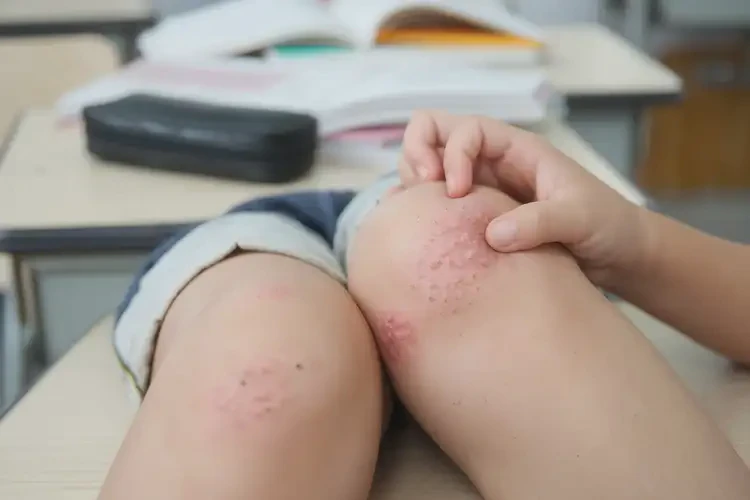 小學(xué)生腳上出濕疹不管它會(huì)自己好嗎(圖4)