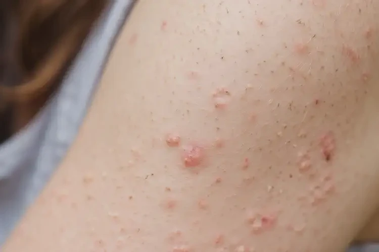 大學(xué)生手臂容易起濕疹可不可以徹底自愈(圖4)