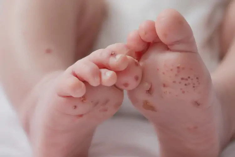 新生兒腳上有濕疹不管它會自己好嗎(圖4)