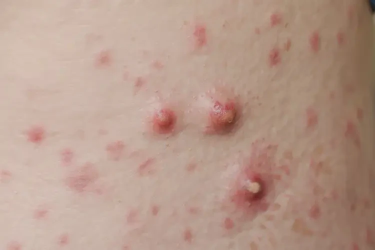 女性肛周長濕疹可以徹底自愈嗎(圖4)