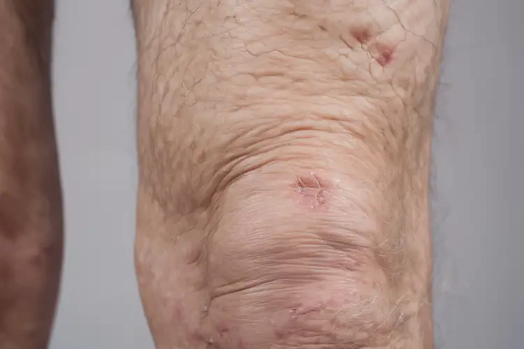 高齡老人大腿容易長濕疹可不可以徹底自愈(圖4)