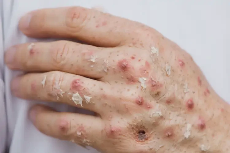 女人手上起濕疹可不可以徹底自愈(圖4)