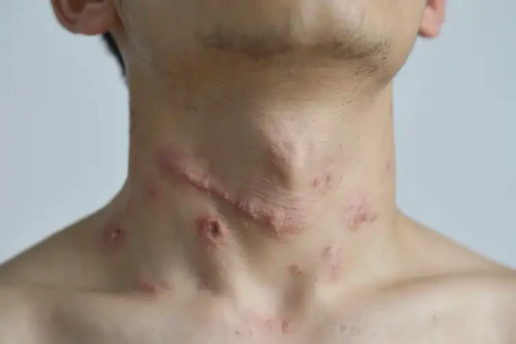 青年人脖子出現(xiàn)濕疹能不能徹底自愈(圖4)