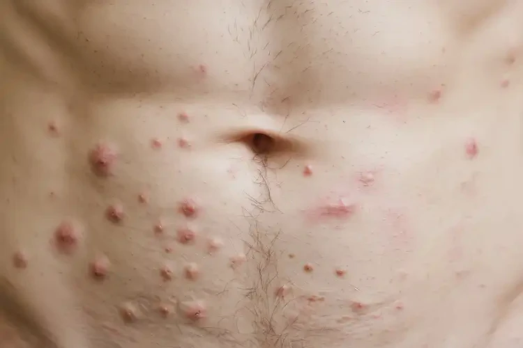 青年人肚子容易起濕疹不管它會自己痊愈嗎(圖4)