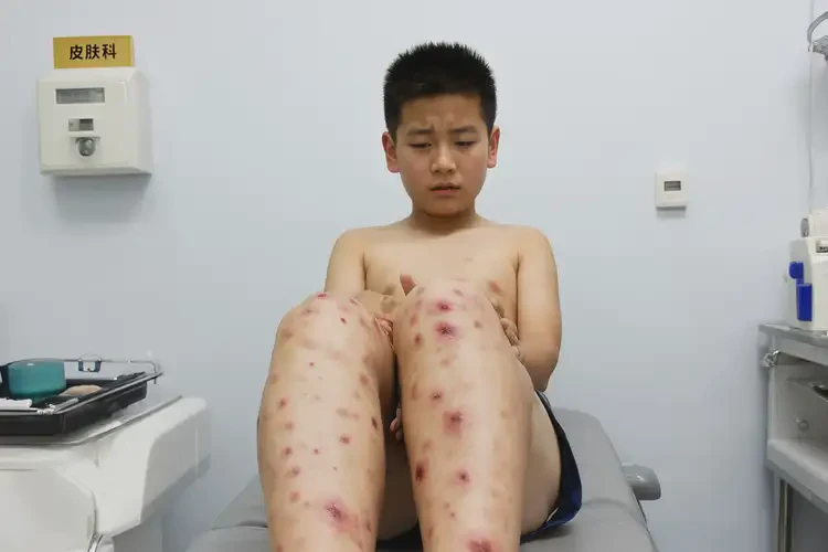 青少年大腿上經(jīng)常長(zhǎng)濕疹不管它會(huì)自己自愈嗎(圖4)