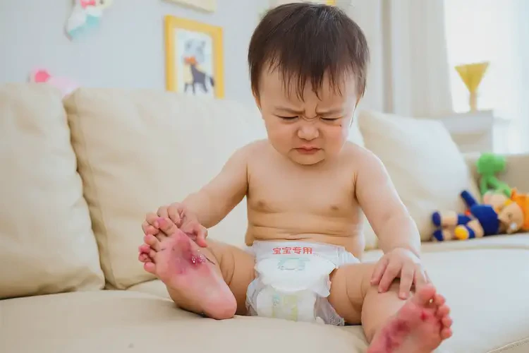 幼兒腳上經(jīng)常長(zhǎng)濕疹可以徹底自愈嗎(圖3)