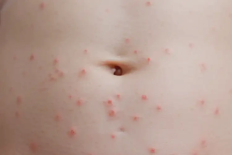 新生兒肚子上有濕疹不管它會自己自愈嗎(圖4)