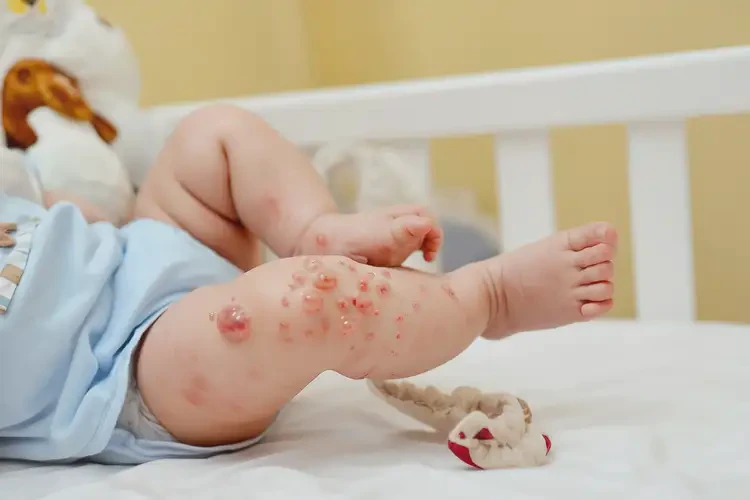 孩子大腿上經(jīng)常長濕疹不管它會自己自愈嗎(圖4)