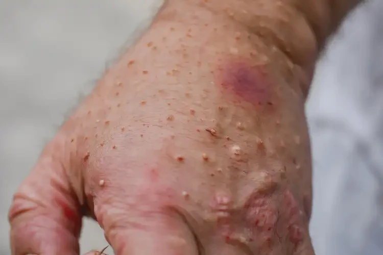 產(chǎn)婦手上經(jīng)常起濕疹能夠徹底治愈嗎(圖4)