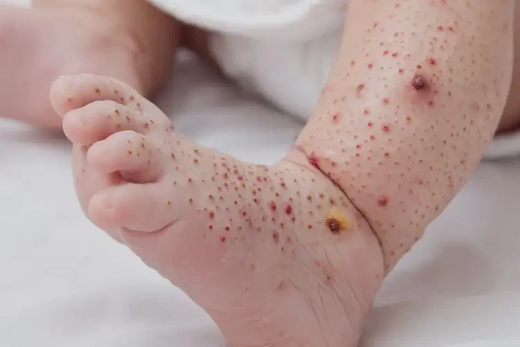 寶寶小腿出濕疹不管它會(huì)自己自愈嗎(圖2)