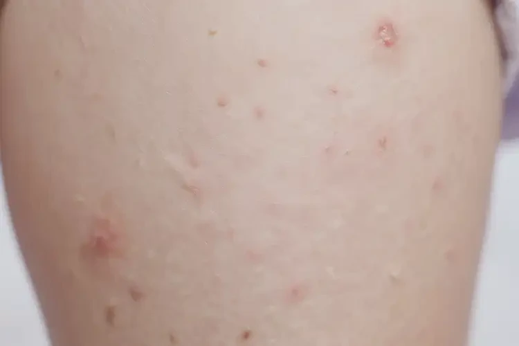 嬰幼兒大腿長濕疹不管它會自己好嗎(圖4)