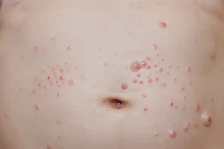 婴儿肚子容易长湿疹不管它会自己痊愈吗(图4)