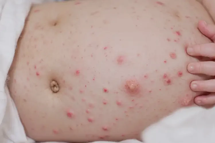 新生兒肚子上有濕疹不管它會自己自愈嗎(圖3)