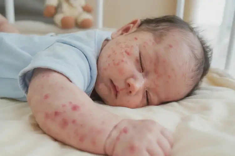 嬰兒身上出濕疹不管它會(huì)自己自愈嗎(圖1)