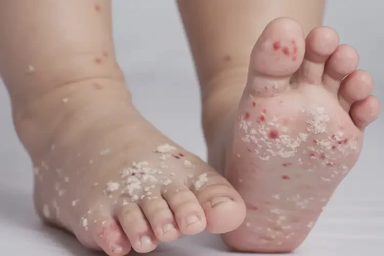 儿童脚上出现湿疹可以彻底自愈吗(图4)