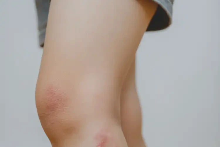 小兒大腿偶爾長濕疹不管它會自己自愈嗎(圖4)