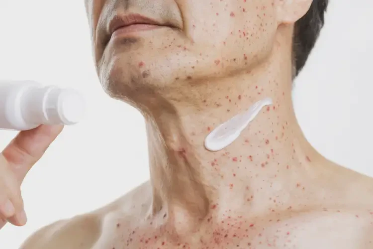 男性脖子經(jīng)常起濕疹可以徹底自愈嗎(圖3)