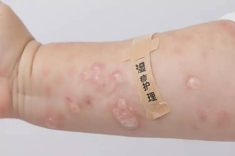 小孩手臂偶爾起濕疹能靠自己自愈嗎(圖3)