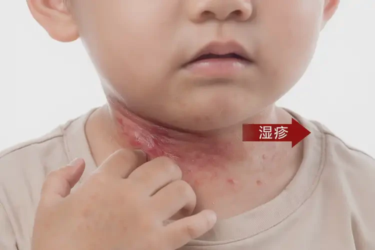 兒童脖子容易起濕疹能靠自己自愈嗎(圖4)