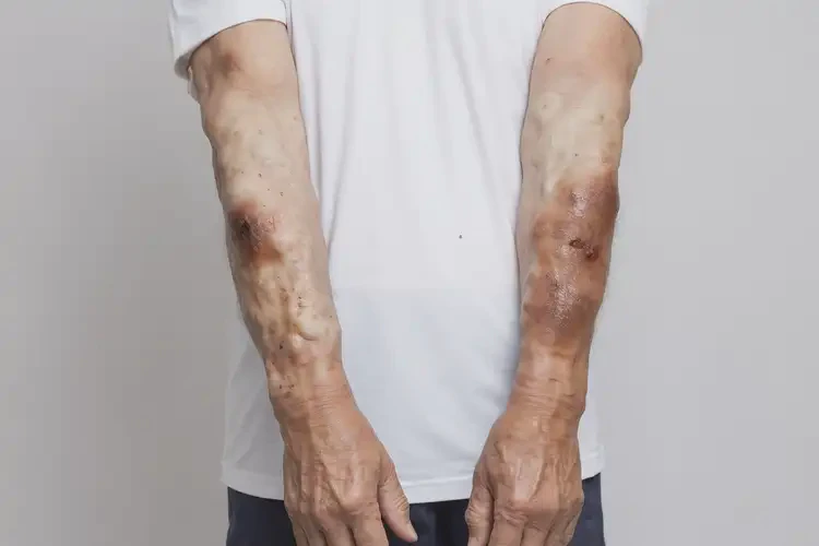 男性四肢偶爾起濕疹可不可以徹底自愈(圖3)