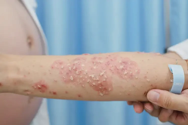 孕婦手臂經(jīng)常起濕疹能徹底自愈嗎(圖4)