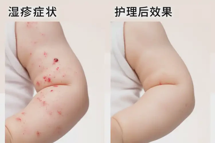 新生兒腳上有濕疹不管它會自己好嗎(圖2)