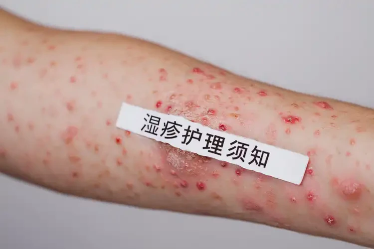 小兒手臂出現(xiàn)濕疹可不可以徹底自愈(圖4)