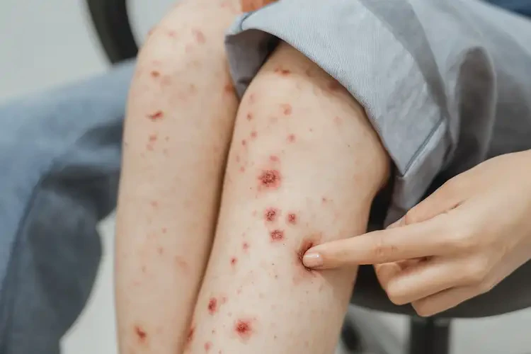 女生小腿上出濕疹不管它會自己痊愈嗎(圖4)