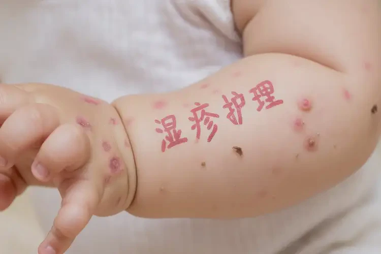 幼兒手臂有濕疹能夠徹底治愈嗎(圖4)