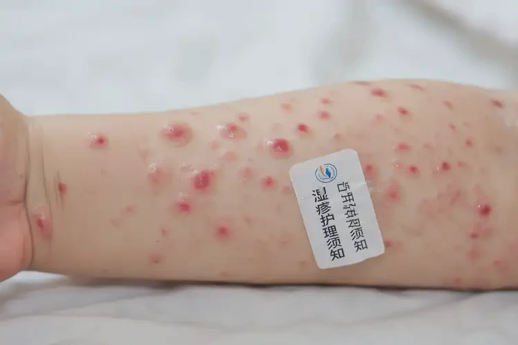 孩子手臂上偶爾長濕疹能夠徹底治愈嗎(圖4)