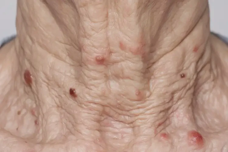 高龄老人脖子上出现湿疹不管它会自己痊愈吗(图4)