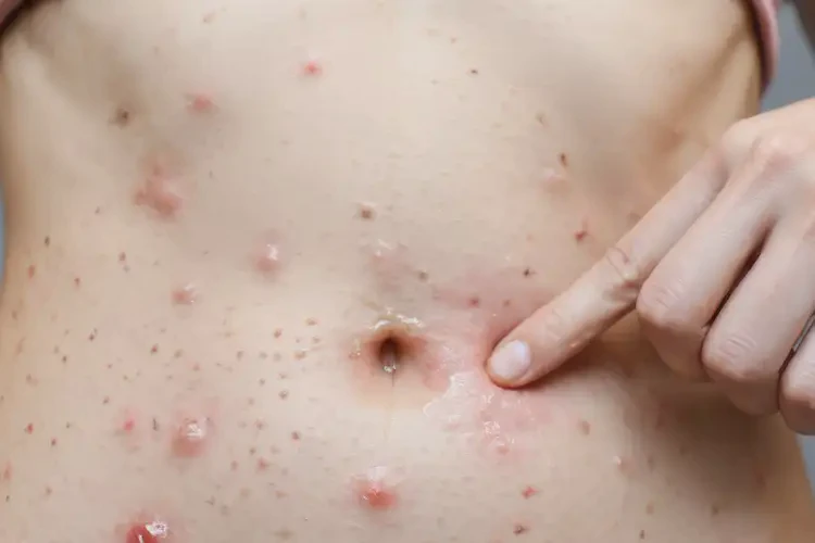 女人肚子容易長濕疹不管它會自己好嗎(圖2)