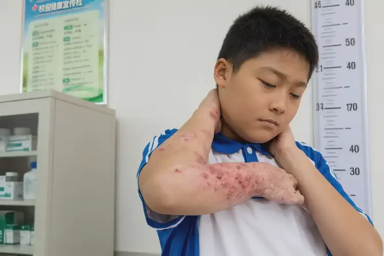 中學(xué)生全身經(jīng)常起濕疹能靠自己自愈嗎(圖4)