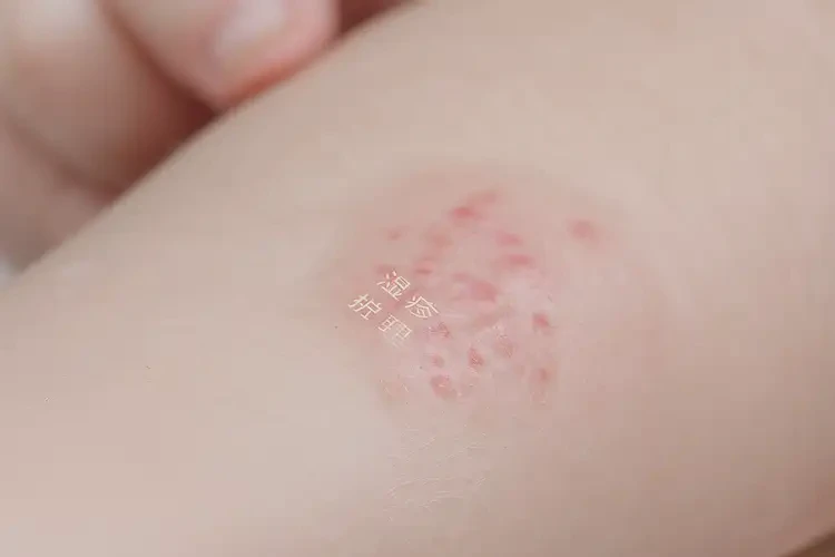 婴儿手臂容易长湿疹能够彻底治愈吗(图4)
